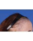 Before Hair Transplant&nbsp;Hairline
